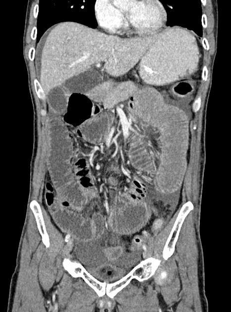 Acute bowel ischemia (Radiopaedia 87695-104114 Coronal C+ portal venous phase 170).jpg