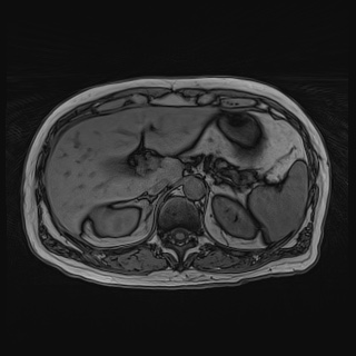 Acute cholecystitis (Radiopaedia 72392-82923 Axial T1 out-of-phase 45).jpg