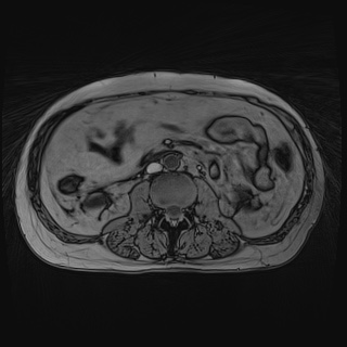 File:Acute cholecystitis (Radiopaedia 72392-82923 Axial T1 out-of-phase 79).jpg