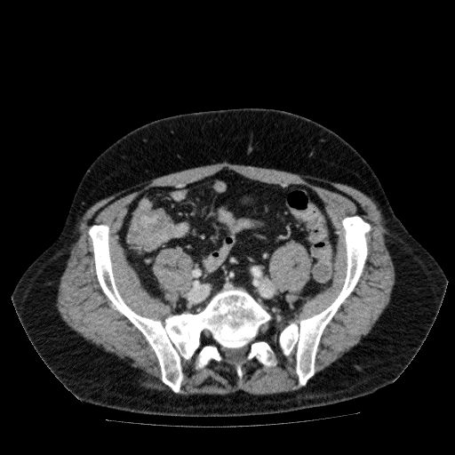 Acute cholecystitis and incidental left sided IVC (Radiopaedia 49352-54459 Axial C+ portal venous phase 113).jpg