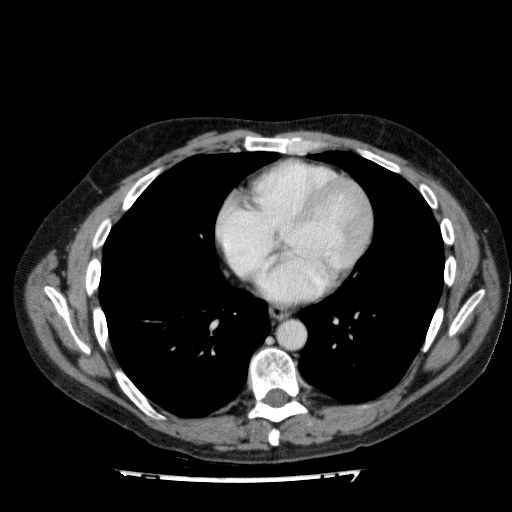 File:Acute cholecystitis and incidental left sided IVC (Radiopaedia 49352-54459 Axial C+ portal venous phase 15).jpg