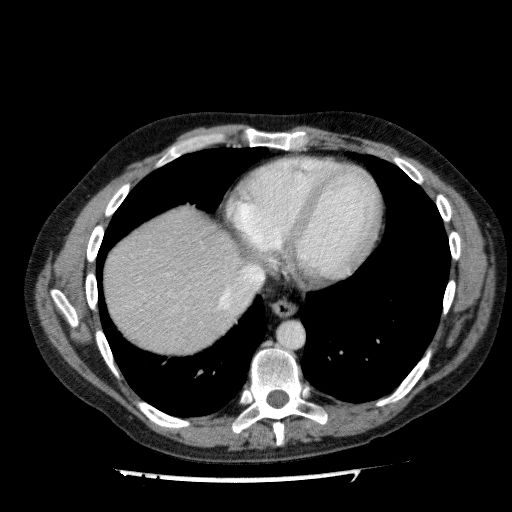 File:Acute cholecystitis and incidental left sided IVC (Radiopaedia 49352-54459 Axial C+ portal venous phase 22).jpg
