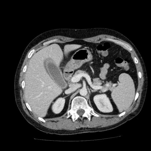 Acute cholecystitis and incidental left sided IVC (Radiopaedia 49352-54459 Axial C+ portal venous phase 52).jpg