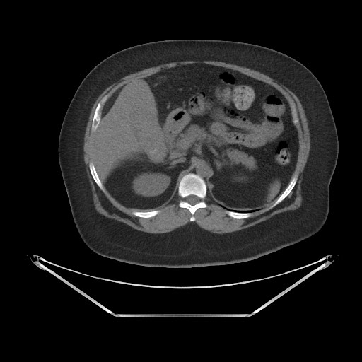 Acute cholecystitis with tensile fundus sign (Radiopaedia 71394-81723 Axial non-contrast 18).jpg