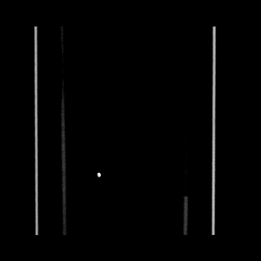 File:Acute cholecystitis with tensile fundus sign (Radiopaedia 71394-81723 Coronal non-contrast 134).jpg