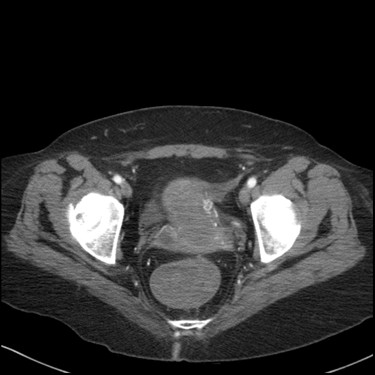 Acute colonic hemorrhage in ulcerative colitis (Radiopaedia 77415-89538 Axial C+ arterial phase 121).jpg