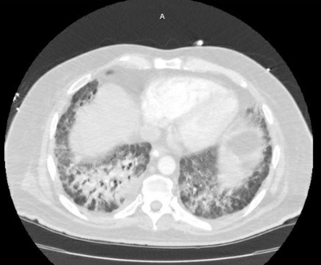 Acute cor pulmonale (ultrasound) (Radiopaedia 83508-98818 Axial lung window 64).jpg