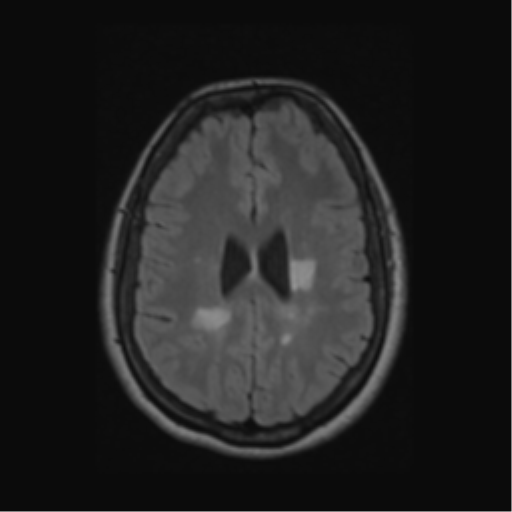 Acute disseminated encephalomyelitis (ADEM) (Radiopaedia 38073-40065 Axial FLAIR 43).png