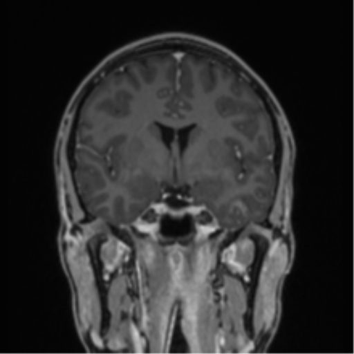 Acute disseminated encephalomyelitis (ADEM) (Radiopaedia 65319-74349 Coronal T1 C+ 29).png
