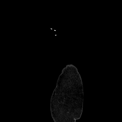 Acute diverticulitis - transverse colon (Radiopaedia 87063-103327 Sagittal C+ portal venous phase 237).jpg