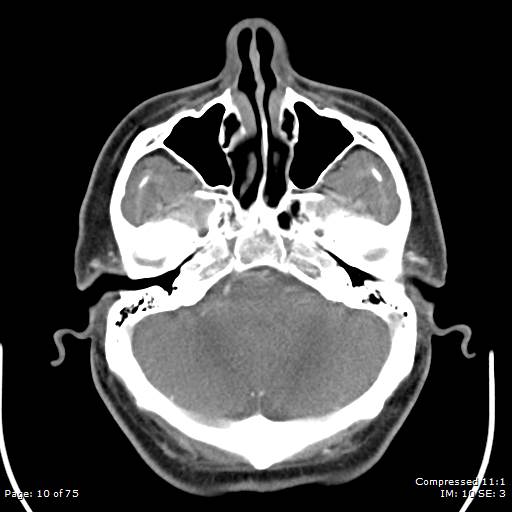 File:Acute epiglottitis (Radiopaedia 54375-60590 Axial C+ arterial phase 10).jpg