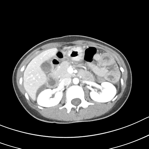 Acute gangrenous appendicitis with perforation (Radiopaedia 40152-42662 Axial C+ portal venous phase 24).png