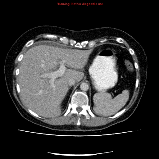 Acute gangrenous cholecystitis (Radiopaedia 10123-10661 Axial C+ portal venous phase 21).jpg