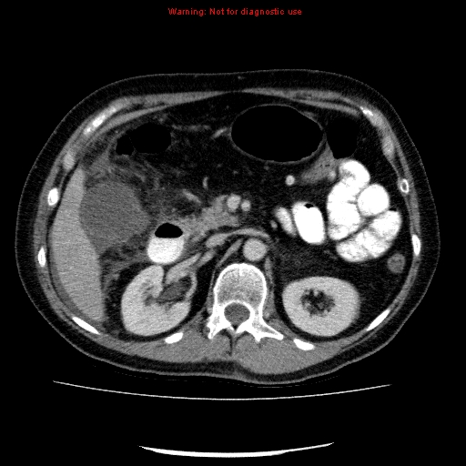 Acute gangrenous cholecystitis (Radiopaedia 10123-10661 Axial C+ portal venous phase 36).jpg