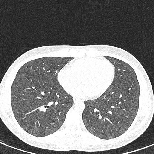 File:Acute hypersensitivity pneumonitis (Radiopaedia 85293-100870 Axial lung window 80).jpg