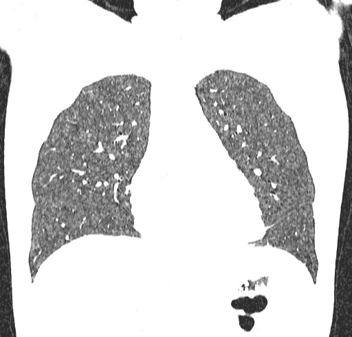 File:Acute hypersensitivity pneumonitis (Radiopaedia 85293-100870 Coronal lung window 39).jpg
