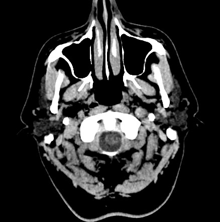 File:Acute internal carotid artery dissection (Radiopaedia 53541-59558 Axial non-contrast 2).jpg