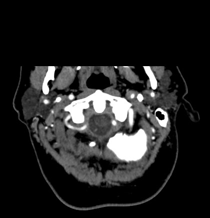 Acute internal carotid artery dissection (Radiopaedia 53541-59630 Axial C+ arterial phase 3).jpg