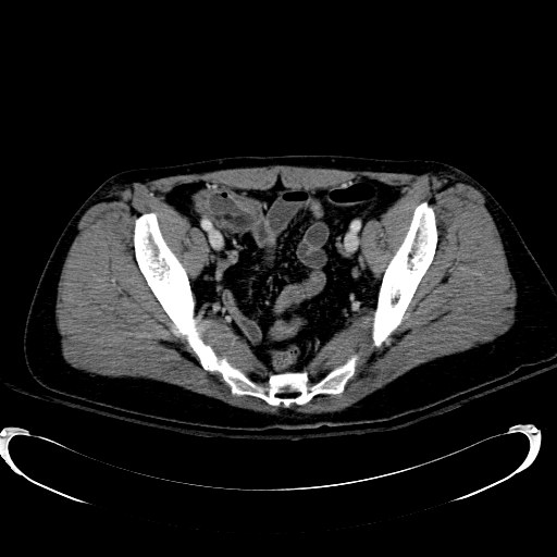 Acute myocardial infarction in CT (Radiopaedia 39947-42415 Axial C+ portal venous phase 111).jpg