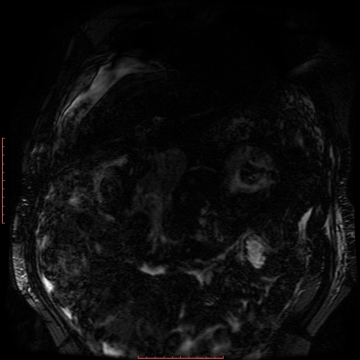 Acute necrotizing pancreatitis (Radiopaedia 28194-28448 Coronal MRCP 79).jpg