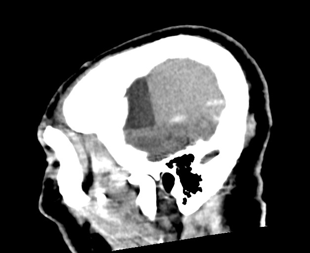 Acute on chronic subdural hematoma (Radiopaedia 78346-90966 Sagittal non-contrast 48).jpg