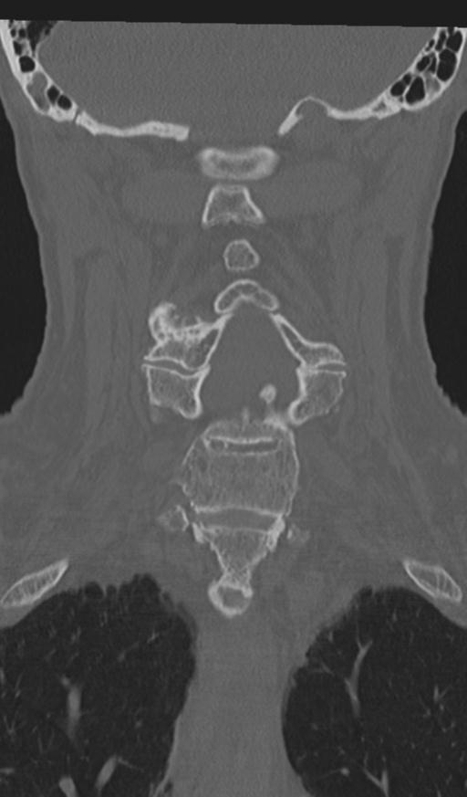 Acute on chronic subdural hematoma and thoracic vertebral injury in a multitrauma patient (Radiopaedia 31698-32619 Coronal bone window 33).jpg
