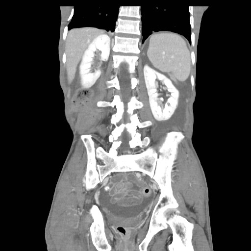 File:Acute pancreatitis (Radiopaedia 50213-55558 Coronal C+ portal venous phase 34).jpg