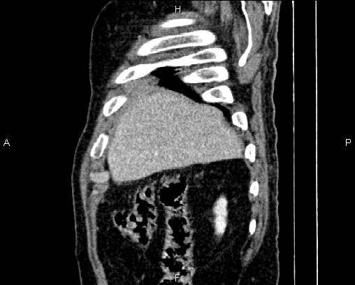 Acute pancreatitis (Radiopaedia 85146-100701 Sagittal C+ portal venous phase 11).jpg