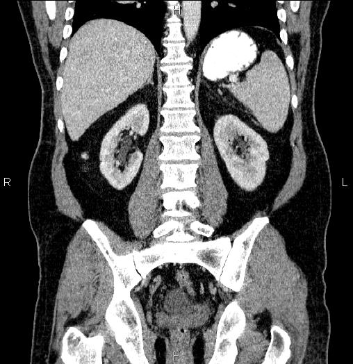 Acute pancreatitis (Radiopaedia 85390-101010 Coronal C+ portal venous phase 50).jpg