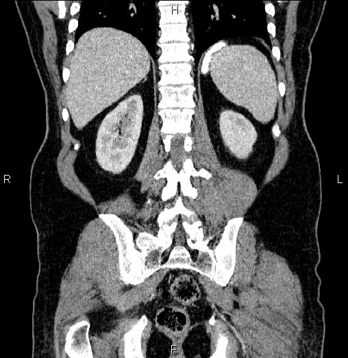 Acute pancreatitis (Radiopaedia 85390-101010 Coronal C+ portal venous phase 56).jpg