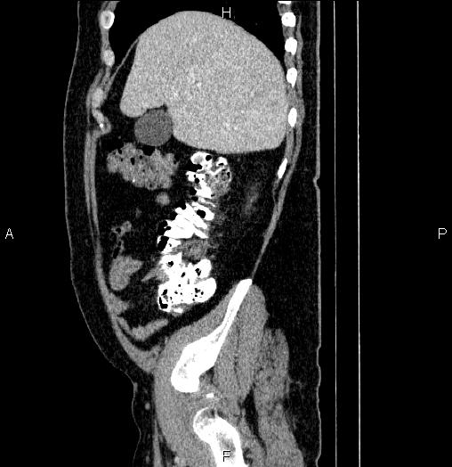 Acute pancreatitis (Radiopaedia 85390-101010 Sagittal C+ portal venous phase 17).jpg