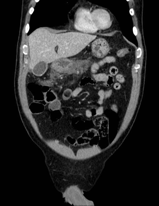 Acute pancreatitis - Balthazar E (Radiopaedia 23080-23110 Coronal C+ portal venous phase 16).jpg