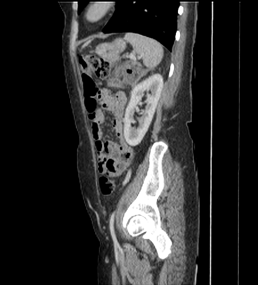 Acute pancreatitis - Balthazar E - post ERCP (Radiopaedia 27562-27772 Sagittal C+ portal venous phase 102).png