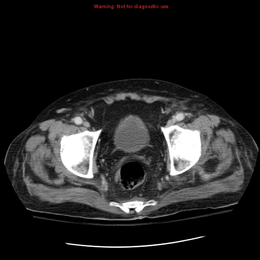 File:Acute pancreatitis with incidental pancreatic lipoma (Radiopaedia 10190-10730 Axial C+ portal venous phase 71).jpg