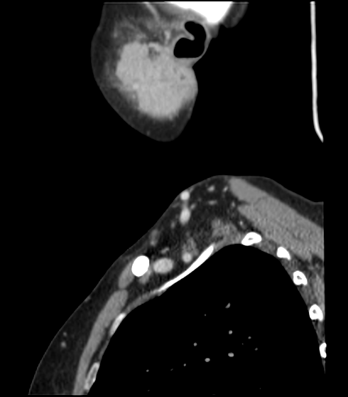 File:Acute parotitis (Radiopaedia 27425-27619 Sagittal C+ portal venous phase 7).png