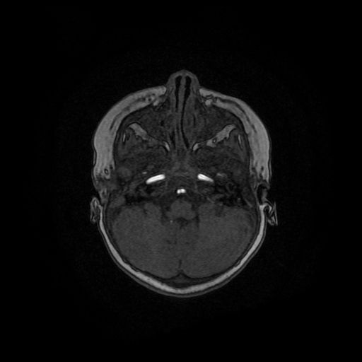 Acute phase of hemiconvulsion-hemiplegia epilepsy syndrome (Radiopaedia 29309-29745 Axial TOF angiography 122).jpg