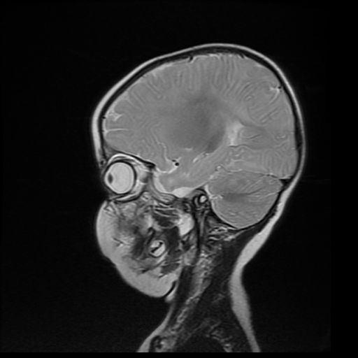 File:Acute phase of hemiconvulsion-hemiplegia epilepsy syndrome (Radiopaedia 29309-29745 Sagittal T2 15).jpg