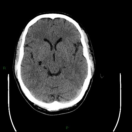 Acute posterior cerebral artery territory infarct (Radiopaedia 79329-92393 Axial non-contrast 46).jpg