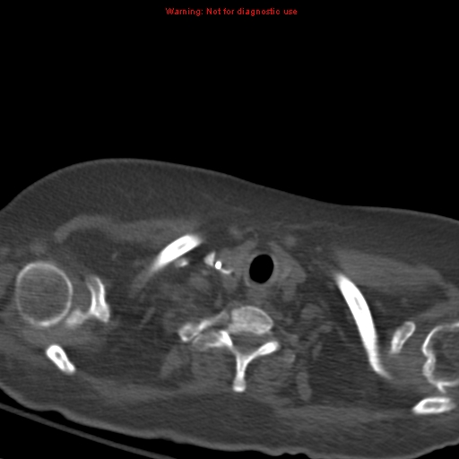 Acute pulmonary embolism (Radiopaedia 13286-13289 Axial C+ CTPA 3).jpg