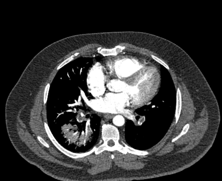 Acute pulmonary embolism with pulmonary infarcts (Radiopaedia 77688-89908 Axial C+ CTPA 36).jpg