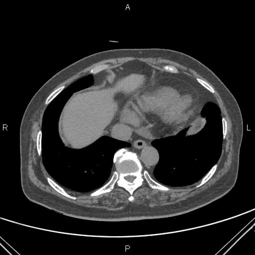 File:Acute renal artery occlusion (Radiopaedia 86586-102682 Axial non-contrast 2).jpg