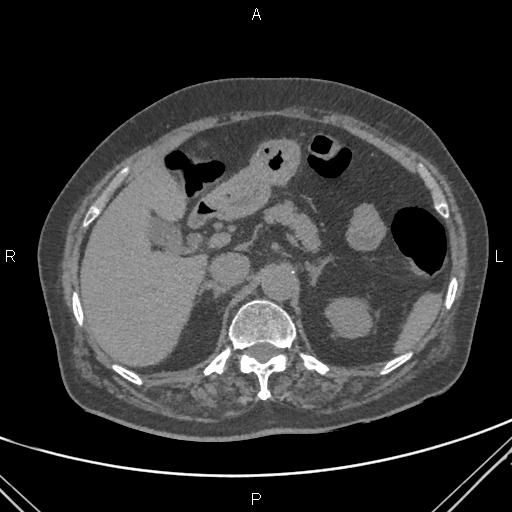 File:Acute renal artery occlusion (Radiopaedia 86586-102682 Axial non-contrast 20).jpg