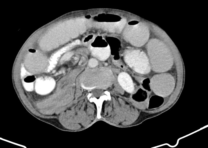 Acute small bowel (ileal) volvulus (Radiopaedia 71740-82139 Axial C+ portal venous phase 104).jpg
