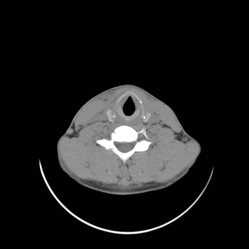 File:Acute submandibular sialadenitis secondary to ductal stone (Radiopaedia 27999-28267 Axial non-contrast 25).jpg