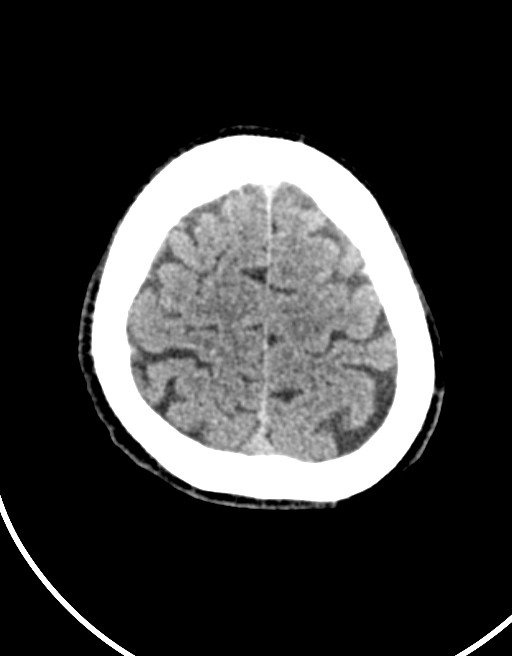 Acute superior cerebellar artery territory infarct (Radiopaedia 84104-99359 Axial non-contrast 16).jpg