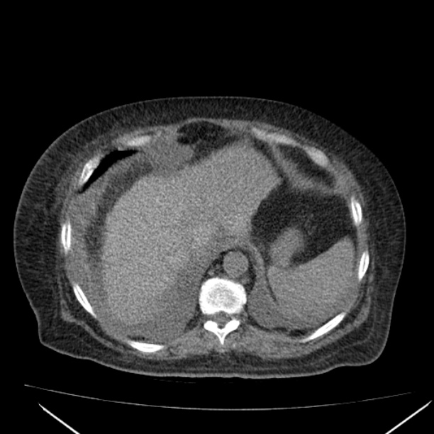 Acute tubular necrosis (Radiopaedia 28077-28334 Axial non-contrast 13).jpg