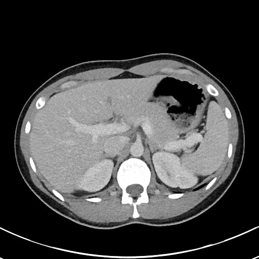File:Acute uncomplicated appendicitis (Radiopaedia 61374-69304 Axial C+ portal venous phase 28).jpg