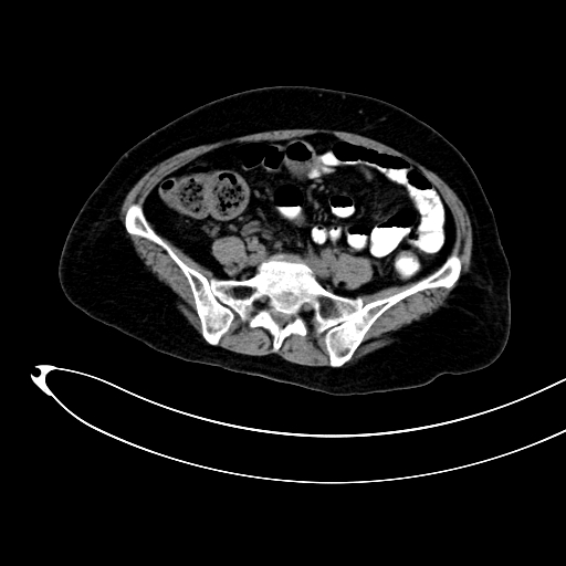 Adenocarcinoma colon with intussusception (Radiopaedia 86006-101922 Axial non-contrast 40).jpg