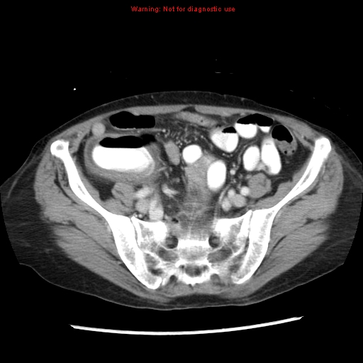 File:Adenocarcinoma of the colon (Radiopaedia 8191-9039 Axial liver window 56).jpg