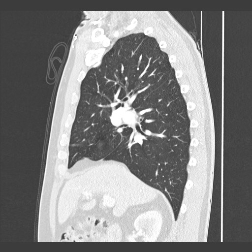 Adenocarcinoma of the lung (Radiopaedia 59871-67325 Sagittal lung window 36).jpg